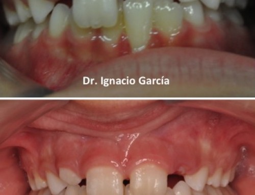Mordida cruzada anterior